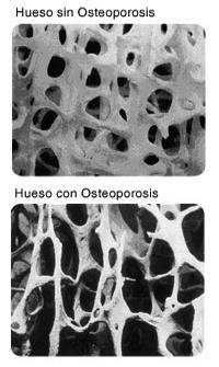 Bone Disorder-Osteoporosis A disease that causes a thinning of the