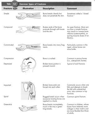49 50 Common Types of Fractures How the Bone Heals 51 52 Joints