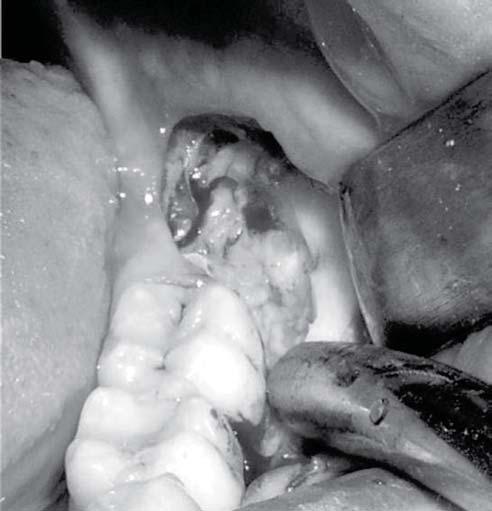 Serbian Dental J, 2007, 54 197 Pacijentu je predočeno da je uz ekstrakciju umnjaka neophodno ukloniti i tumorsku formaciju koja je uočena iznad krune zuba koji je potrebno hirurški izvaditi.