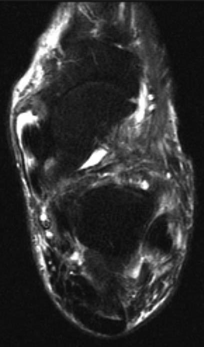 Posterior Tibial Tendon Pathology Tenosynovitis precipitated by training errors Pronated feet Direct medial ankle trauma Systematic