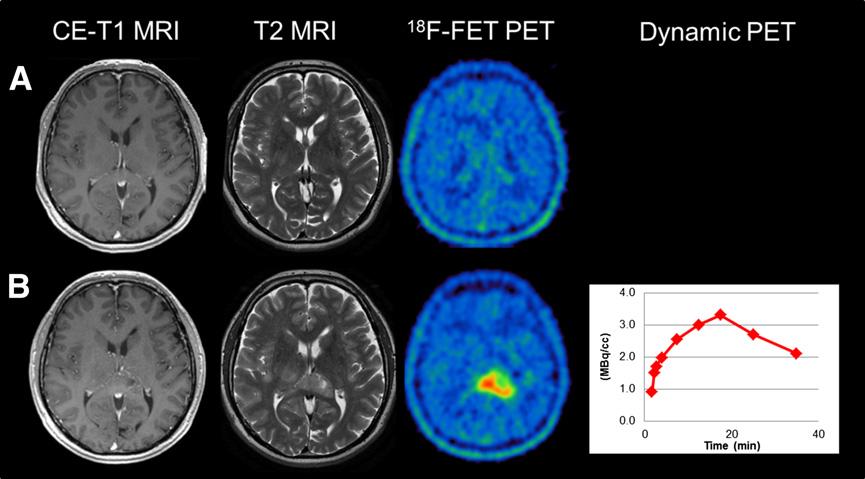 FIGURE 1. Example of a patient with F-FET negative diffuse astrocytoma (WHO grade II) in left occipital lobe (A) presenting with first occurrence of enhanced F-FET uptake after 8 mo (TBR max, 3.