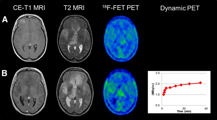 F-FET PET scan most likely indicates no malignant transformation at that point of time.
