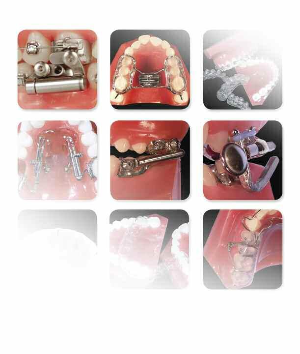 Section Eleven Allesee Orthodontic Appliances page 2 AOA Personal Services page 3 Simpli5 page 4 Breathe Easy page 5 AdvanSync page 6 Miniscope Herbst page 7 MARA page 8 Distalizers page 9 AOB