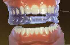 SECTION 11 PAGE 4 ALLESEE ORTHODONTIC APPLIANCES Breathe Easy Sleep - Snoring Obstructive sleep apnea (OSA) can be treated in many patients with the use of a removable dental appliance.