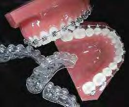 SECTION 11 PAGE 14 ALLESEE ORTHODONTIC APPLIANCES Labial Indirect Bonding Adding indirect bonding to your routine makes the best use of technological advances in today s bracket and archwire systems.