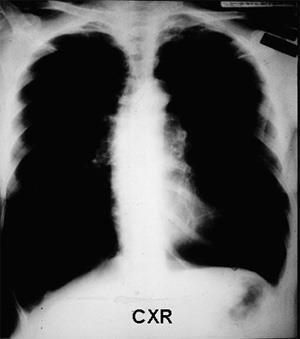 What is emphysema? There is permanent enlargement of the alveoli due to the destruction of the walls between alveoli.