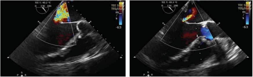 Figure 3. Intraprocedural TEE, bicommisural view (left) and long-axis view at 120 degrees (right). Positioning of device at A2-P2 is visible.