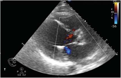 Silvia Iancovici et al. Figure 6. TTE parasternal long-axis view with color Doppler examination reduction of the MR jet to minimal.
