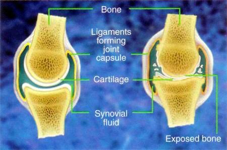 wears down which causes pain and limits movement Bones missing the CALCIUM network!