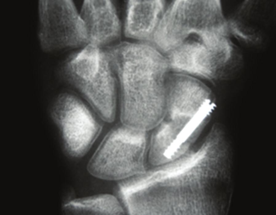 2 Case Reports in Orthopedics Figure 1: AP-radiograph of a 16-year-old patient in the follow up after screw fixation of a scaphoid fracture showing bandlike subchondral osteoporosis in all carpal