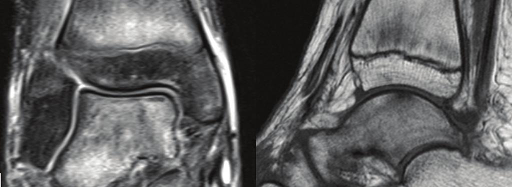 Case Reports in Orthopedics 3 Figure 3: A coronal fat suppressed T2-weighted image and a