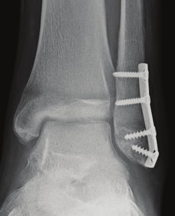 osteochondral flake fracture in a 17-year-old patient.