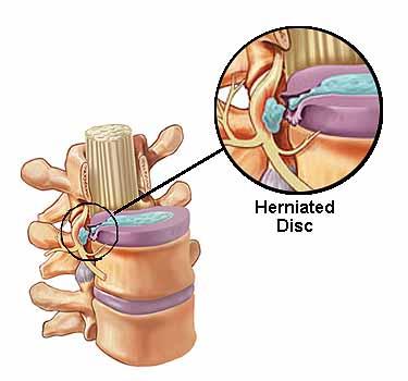 Cause o Trauma o Repetitive stress o Degeneration of the discs Symptoms o Gradual to sudden o Low back pain o Radiculopathy Treatment o