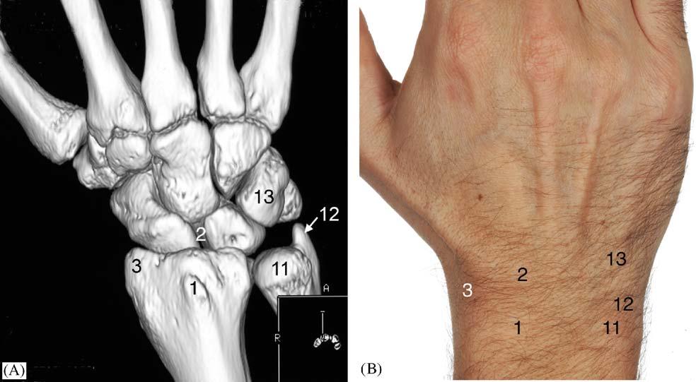 174 Surface anatomy landmarks The following routine is used by the senior author to teach and demonstrate the surface anatomy of the carpal bones.