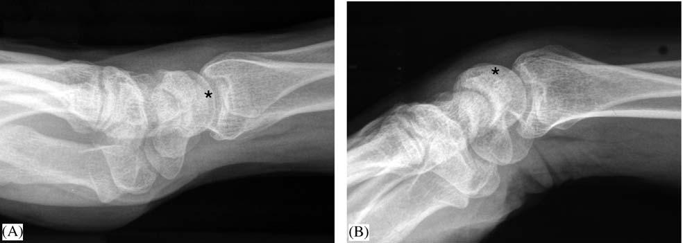 Examination of the wrist surface anatomy of the carpal bones 175 Figure 4 X-rays of lateral views of the wrist in neutral (A) and in palmar flexion (B).