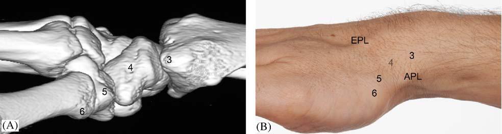 wrist in flexion. Figure 5 Lateral (radial) view of the carpus and wrist as 3D CT reconstruction (A) and clinical photograph (B).