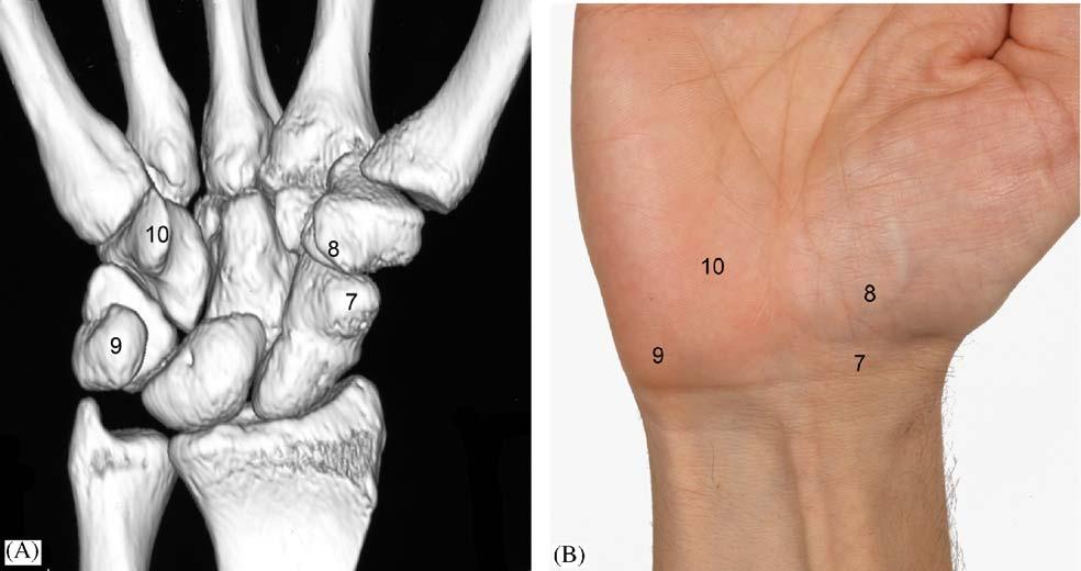 Figure 7 Palmar view of the carpus and wrist as 3D CT reconstruction (A) and clinical photograph (B).