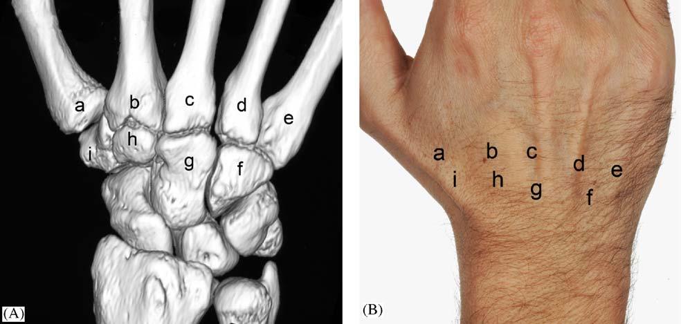 Landmarks in both figures are (11) head of ulna, (12) ulnar styloid process, (13) triquetrum.