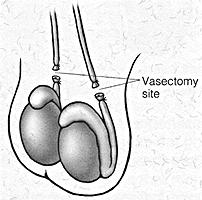 Sperm moves from the epididymis through each vas deferens to the prostate, located in front of the bladder. When ejaculation occurs, sperm is expelled from the penis.
