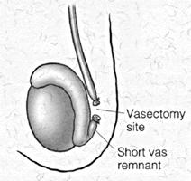 Figure 7a and 7b A disruption of the vas deferens farther away from the testicle will leave a long length of vas deferens (vas remnant) and increase the chance of a successful reversal.