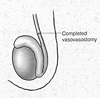There are two types of vasectomy reversals: Vasovasostomy and Vasoepididymostomy. Vasovasostomy is the operation most frequently performed for vasectomy reversal.