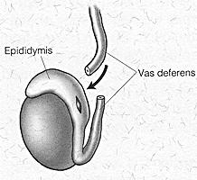 the problem. To bypass the blockage in the epididymis, a vasoepididymostomy must be performed.