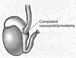 The outer layer of both the vas deferens and