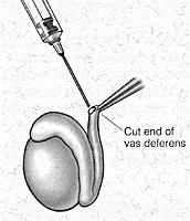 Figure 6 In general, if sperm is present in the vas fluid, a vasovasostomy is performed. If sperm is not present in the vas fluid, a vasoepididymostomy is performed.