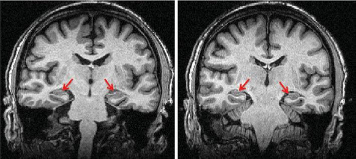 7 Case 1 Fig. 1.1. MRI (T1 coronal slices) showing minimal cerebral atrophy especially in the hippocampal regions (arrows). Examination BP: 140/80; pulse: 65 regular.