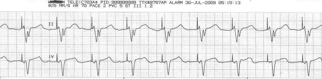 T = Triggered When the pacemaker activates a depolarization wave to a sensed event An example of a triggered response is when the pacemaker fires an impulse to the ventricles after it senses an
