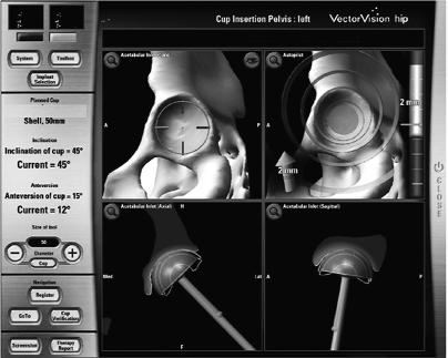 120 SESSION 4.1 Imaging Methods Image-free navigation Each surgeon must make a choice about what, if any, images are used as part of computer-assisted total hip arthroplasty techniques.