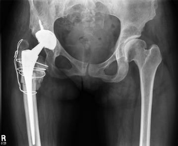 Since fluoroscopic navigation is very versatile, it is especially useful in very complex cases, such as conversion of a hip fusion to a total hip arthroplasty (Fig. 2).