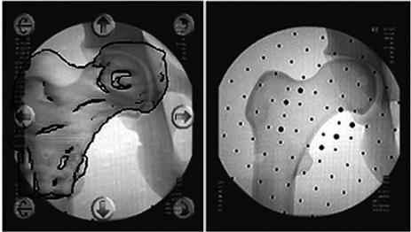 The Ceramic Option: Indications, Contraindications, Revision and Surgical Challenges 123 Figure 4: CT-fluoro registration utilizes intraoperatively acquired fluoroscopic images to register a