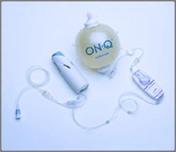 Background An elastomeric infusion pump (such as a brand like the On-Q) places
