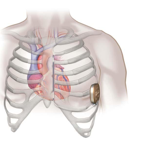 ICD IMPLANT LOCATION THE DIFFERENCE IS IN THE LOCATION. Unlike a traditional ICD, the S-ICD is placed just under the skin with no wires touching the heart.