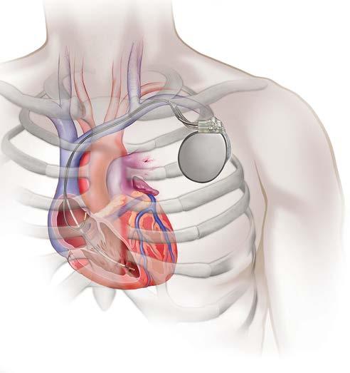 S-ICD IMPLANT LOCATION The S-ICD may be a good option for you, especially if you live an active lifestyle.