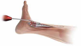 The plate conforms to the shape of the distal tibia and the distal end of the plate should conform to the shape of the medial malleolus (Figure 17).