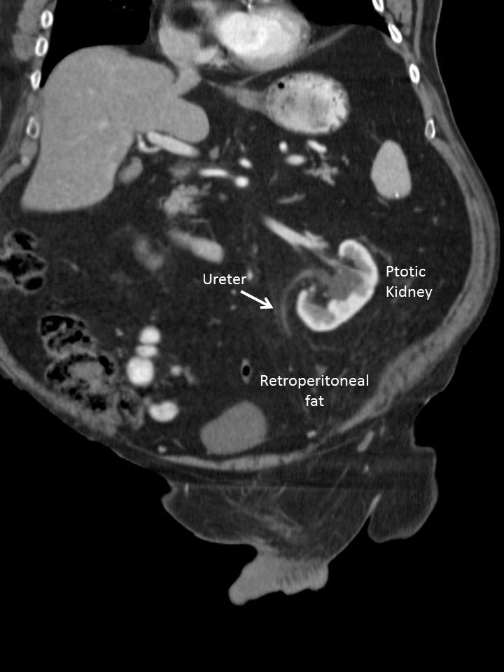 94 95 96 97 Figure 2: Coronal section of computerized tomogram with contrast showing incarcerated fatty hernia.