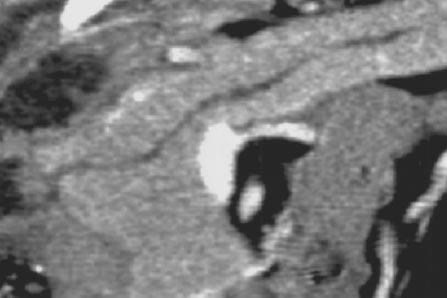 CT of the Pancreas and ile Duct System Downloaded from www.ajronline.org by 46.3.207.229 on 02/03/18 from IP address 46.3.207.229. Copyright RRS.