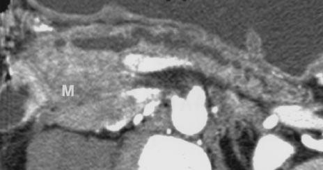 In a patient suspected of having a pancreas divisum, these reformations can confirm the diagnosis by clearly depicting the entire pancreatic duct with its opening in the minor papilla (Fig. 3).