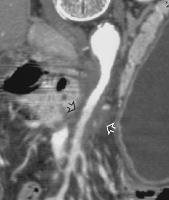 54-year-old woman with pancreatic carcinoma. Curved planar reformation of pancreas reveals small hypodense pancreatic mass (straight arrow) causing partial obstruction of duct.