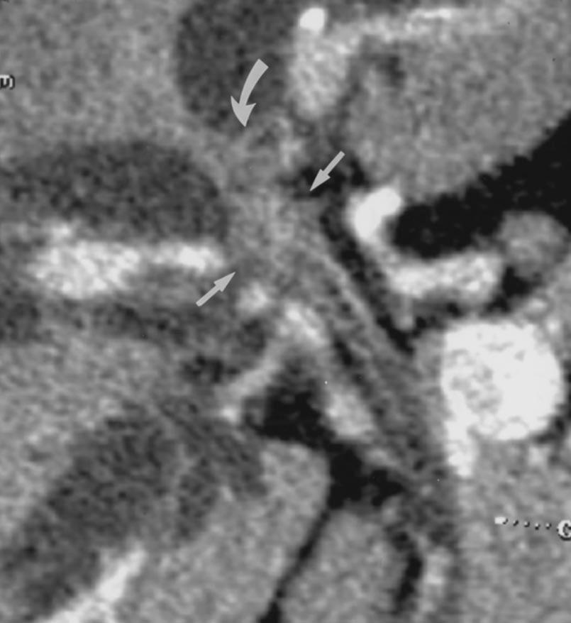 CT of the Pancreas and ile Duct System Fig. 11. 47-year-old man with necrotizing pancreatitis and occlusion of splenic vein.