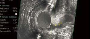 Endosonographic ultrasound Combination of two modalities