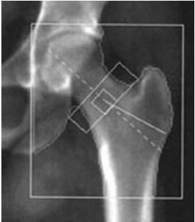 Bone Mineral Density (DXA) Interpretation of DXA Scans: Really Confusing Absolute mineral (calcium) content using x-rays Relative to young adult