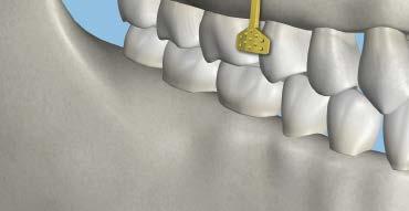 Notes For optimal retention, insert screw perpendicular to cortical bone If the plate anchor screw becomes loose in the