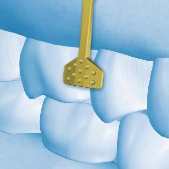 this will require the same uv-cure adhesive normally used to bond the orthodontic bracket to a tooth.