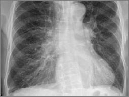 toward TB elimination by screening close contacts,