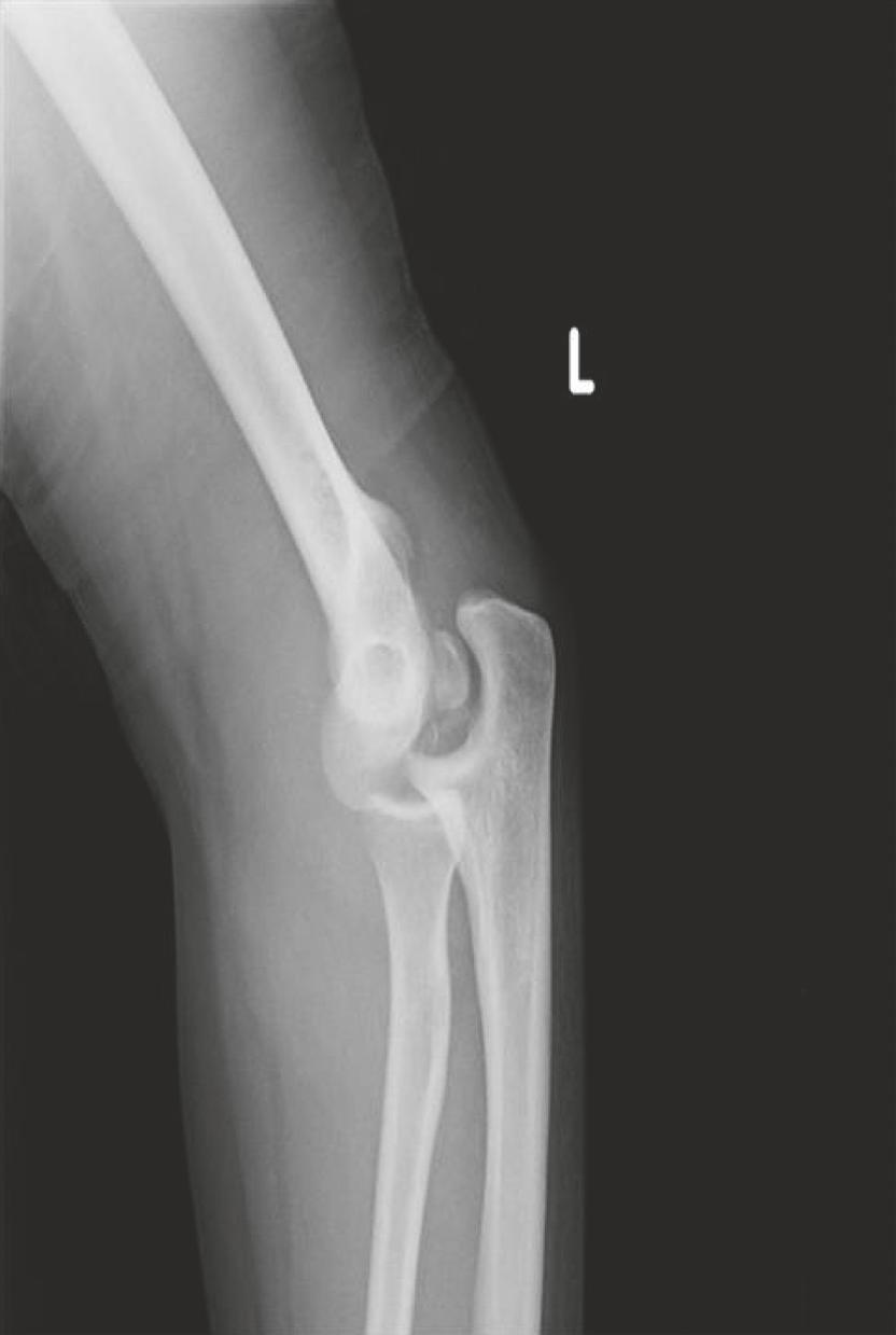 2 CaseReportsinOrthopedics Figure 1: Lateral and anteroposterior radiographs of the left elbow joint