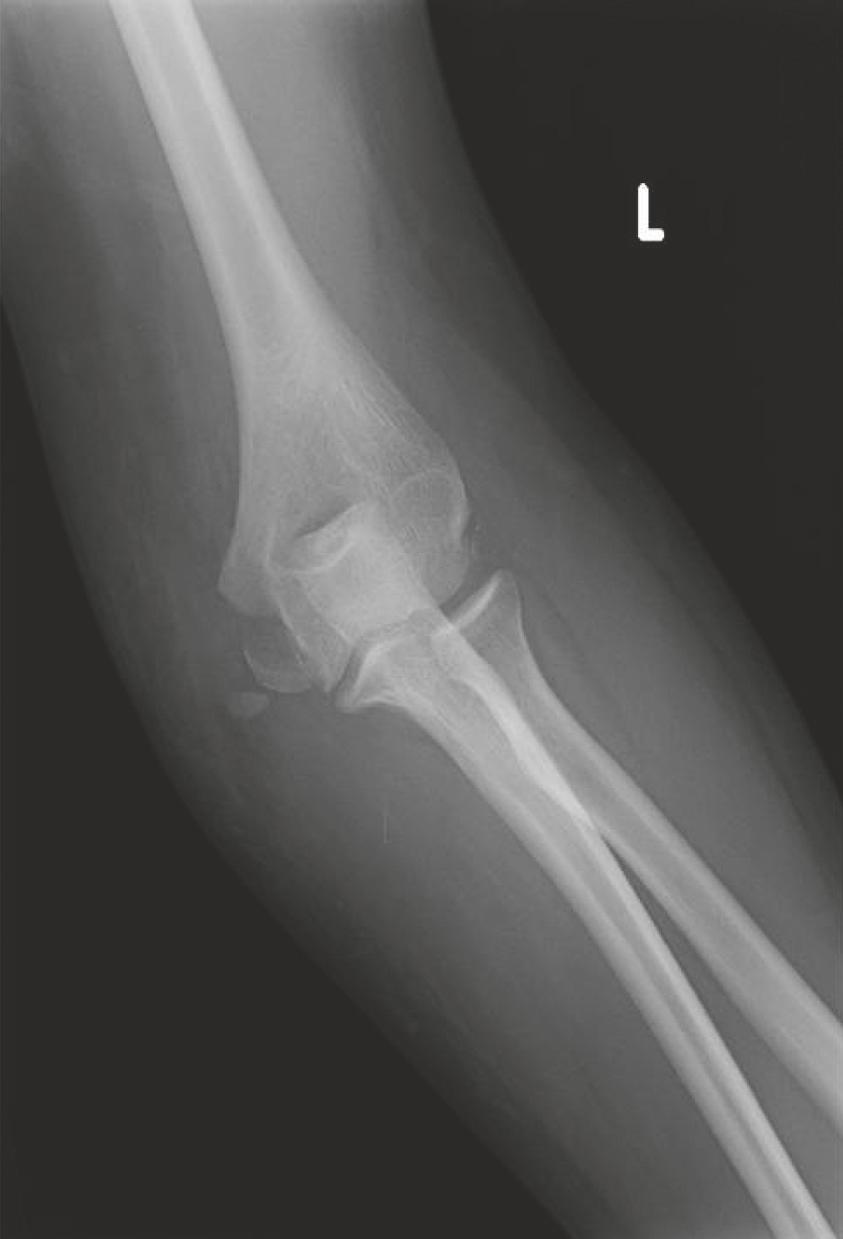 showing a displaced medial epicondyle avulsion fracture.