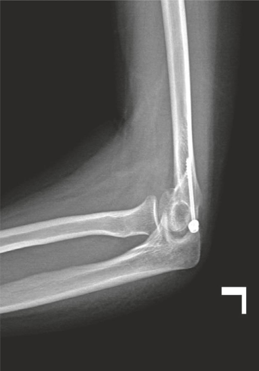 CaseReportsinOrthopedics 5 Figure 5: Left elbow control X-rays done at 3 weeks postop that showed proper